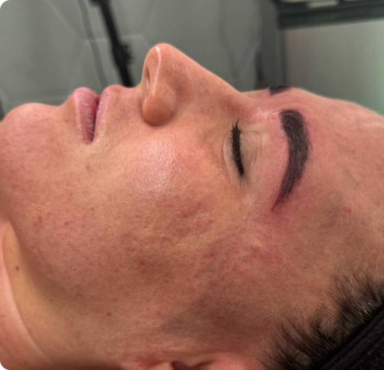 After nine microneedling treatments: cheek appears smoother with softened acne scarring