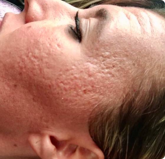 Before microneedling: cheek with indented acne scarring and uneven texture