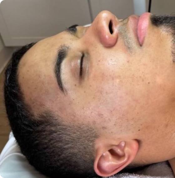 After four microneedling treatments: clearer looking cheek with reduced discoloration