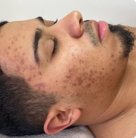 Before microneedling: cheek and temple with active acne marks and post-inflammatory discoloration