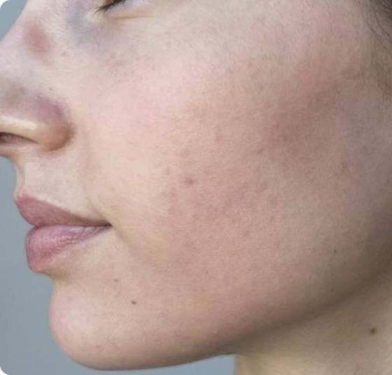 After four microneedling treatments: cheek and jawline look calmer and more even in tone