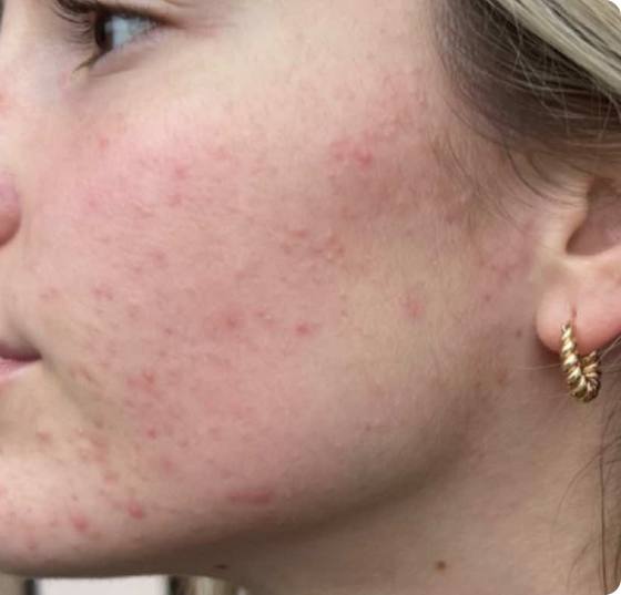 Before microneedling: cheek and jawline with breakouts and red acne marks