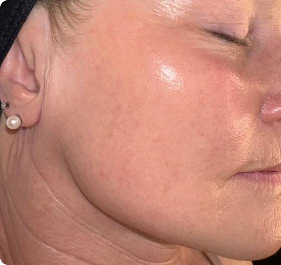 After three microneedling treatments: jawline and neck skin appears smoother and firmer