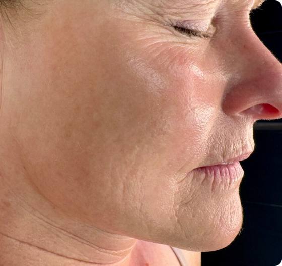 Before microneedling: jawline and neck with crepey-looking lines and lax skin