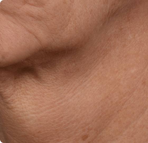 After four microneedling treatments: neck lines appear softened and texture more even