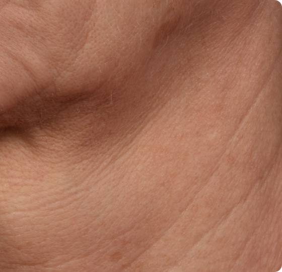 Before microneedling: close-up of neck with horizontal lines and crepey texture